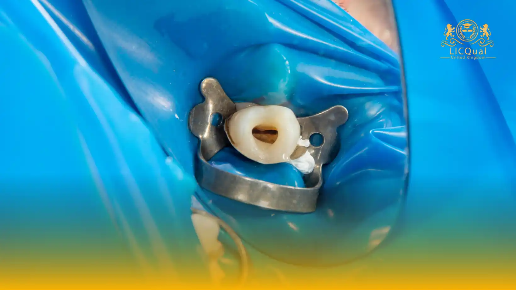 LICQual Level 6 Diploma in Endodontics (Dip Endodontics)