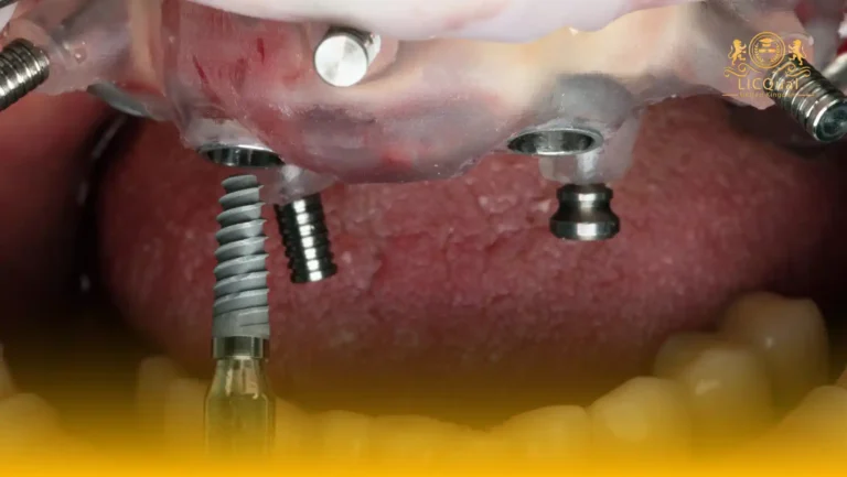LICQual Level 6 Diploma in Implant Dentistry (Dip Implant Dentistry) 