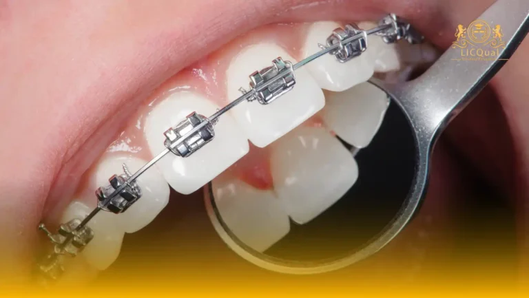 LICQual Level 6 Diploma in Orthodontics (Dip Orthodontics)